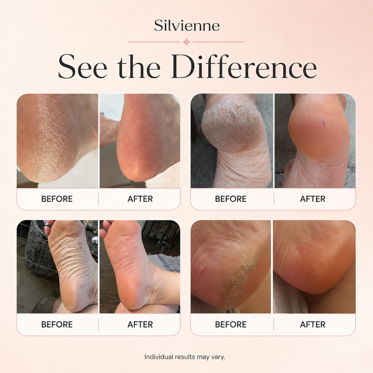 Examples of smoother-looking feet after using an electric foot smoother; individual results may vary